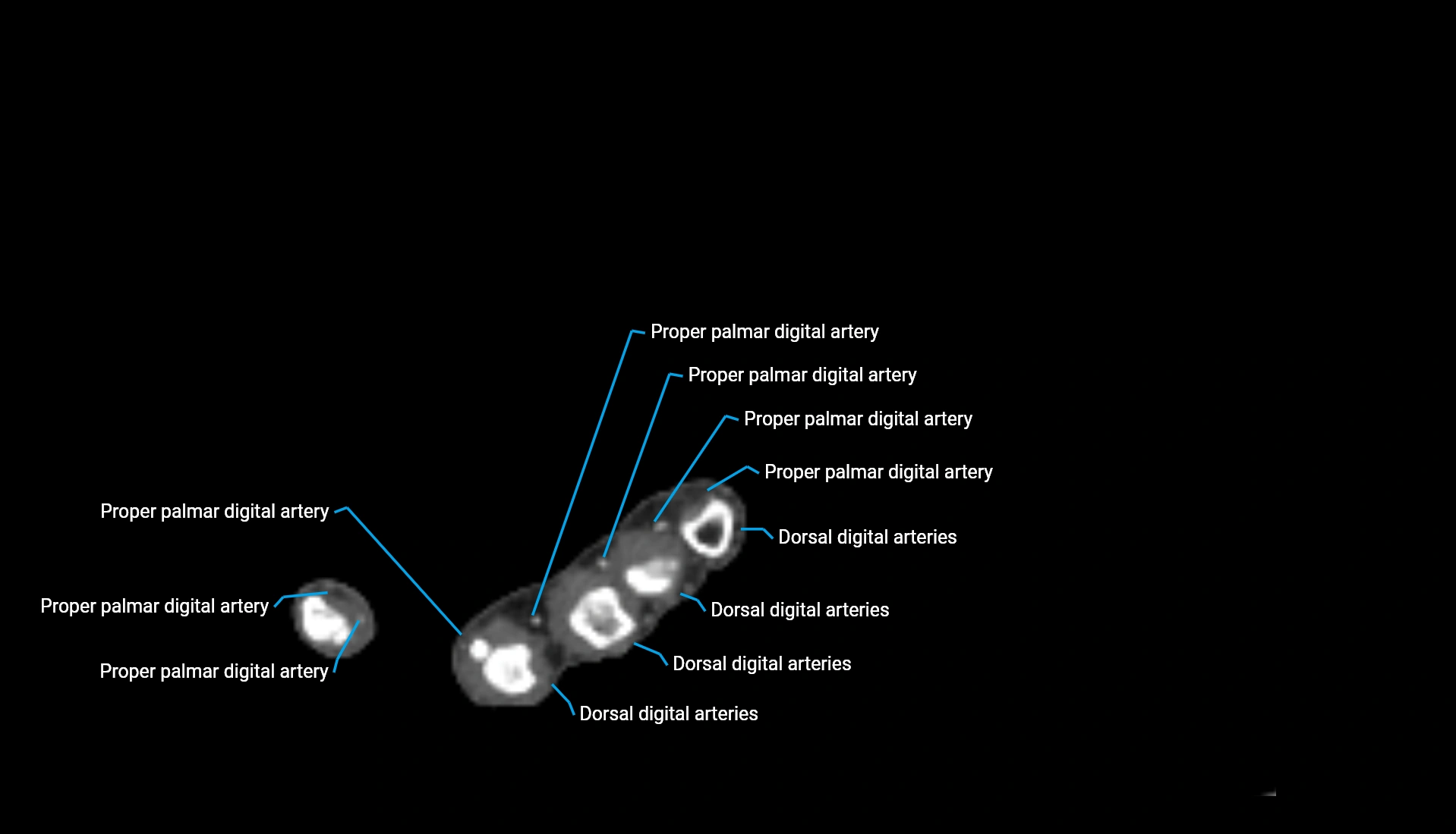 CTA upper limb axial cross sectional anatomy labelled image 45 (2).webp